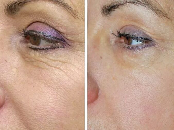 Terenski laser prije i poslije