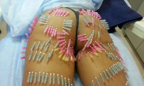 podizanje stražnjice